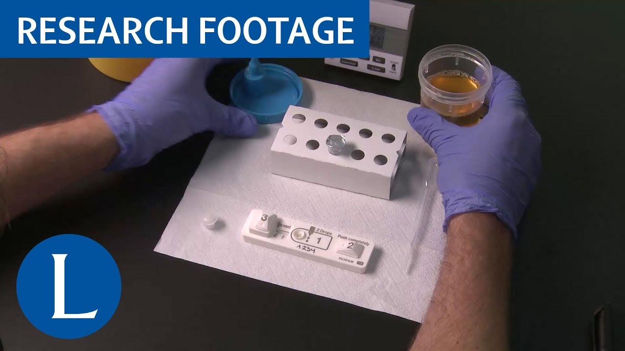 Novel lipoarabinomannan point-of-care tuberculosis test for people with HIV