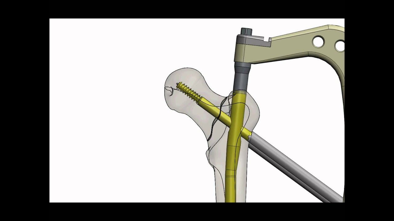 A-PFN (Antirotator Proksimal Femur Çivisi)  (Antirotator Proximal Femoral Nail)