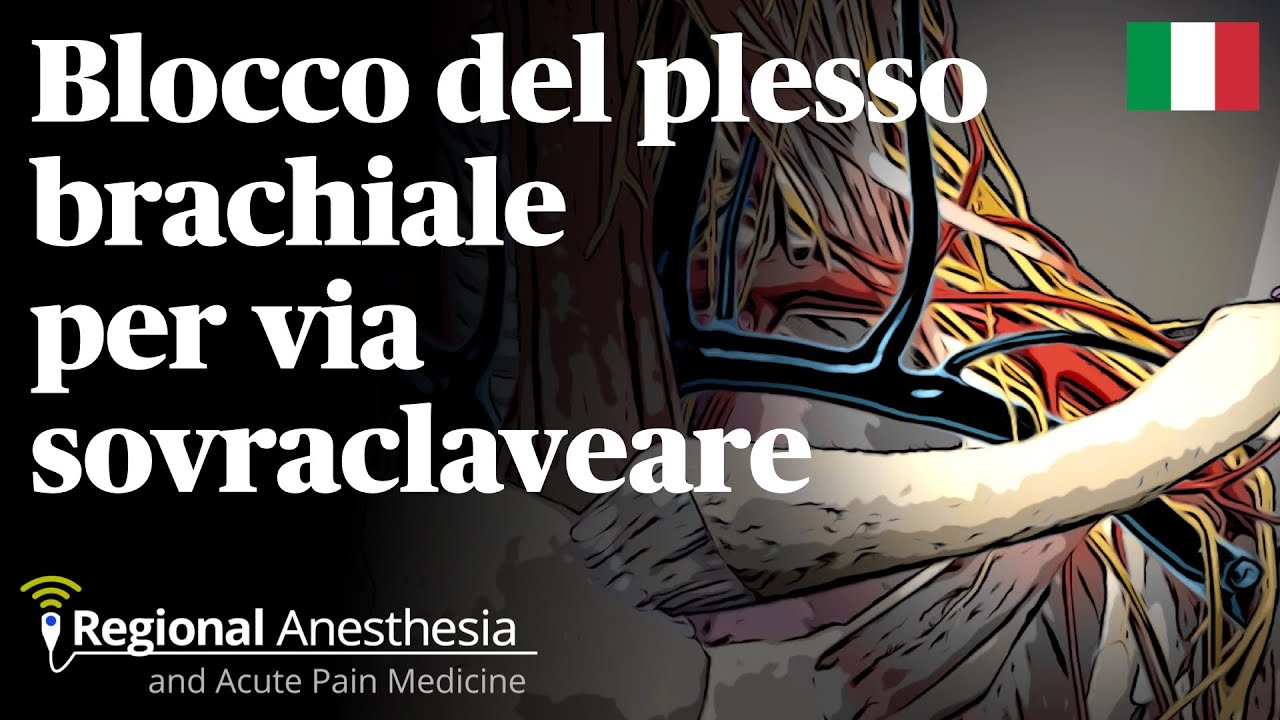 Blocco del plesso brachiale per via sovraclaveare