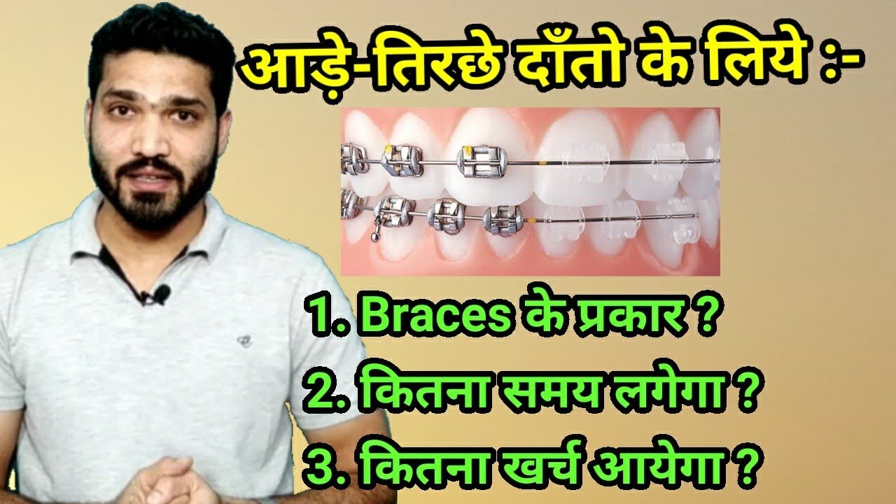 Braces lagwane ka time or kharch ? kitne prakar k hote hai braces?