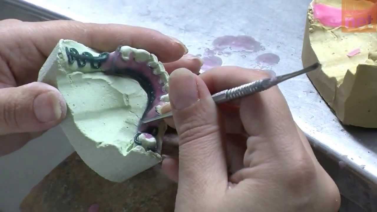 Confección de la estructura colada de una protesis parcial removible - Lección práctica UCV