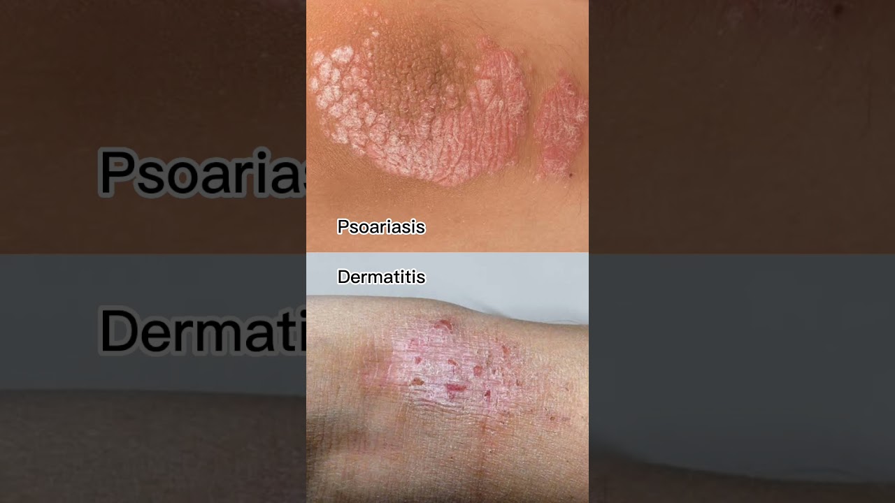 Penanganan Radang Kulit Dermatitis Eksim Psoariasis