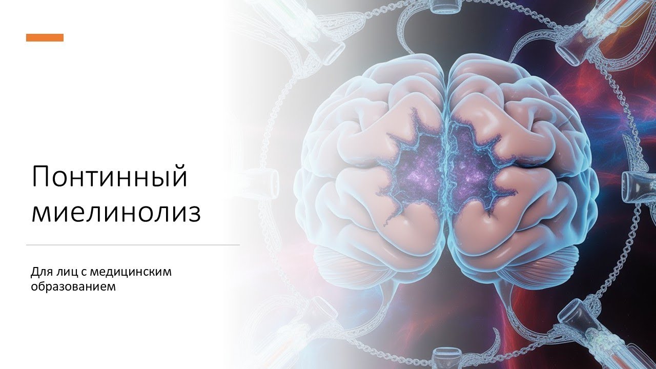 Понтинный миелинолиз