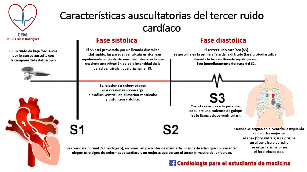Tercer ruido cardiaco