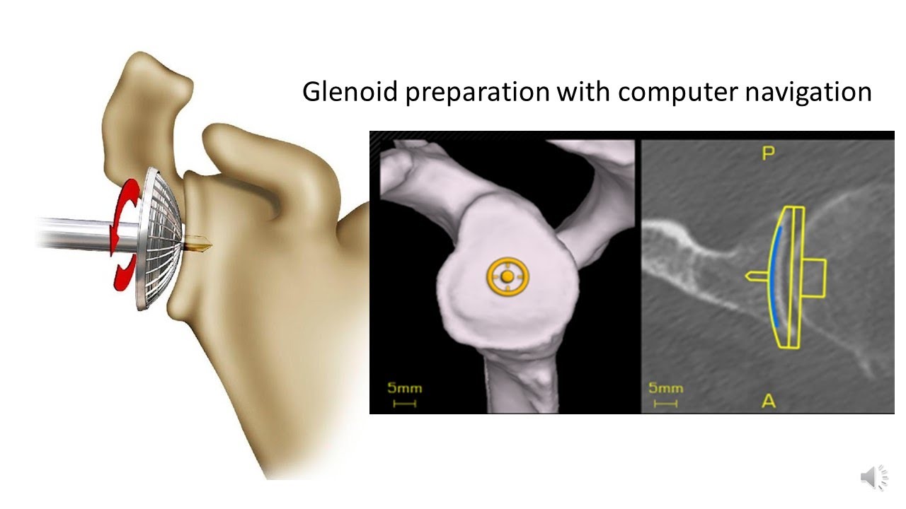 Total Shoulder Replacement- surgical  technique