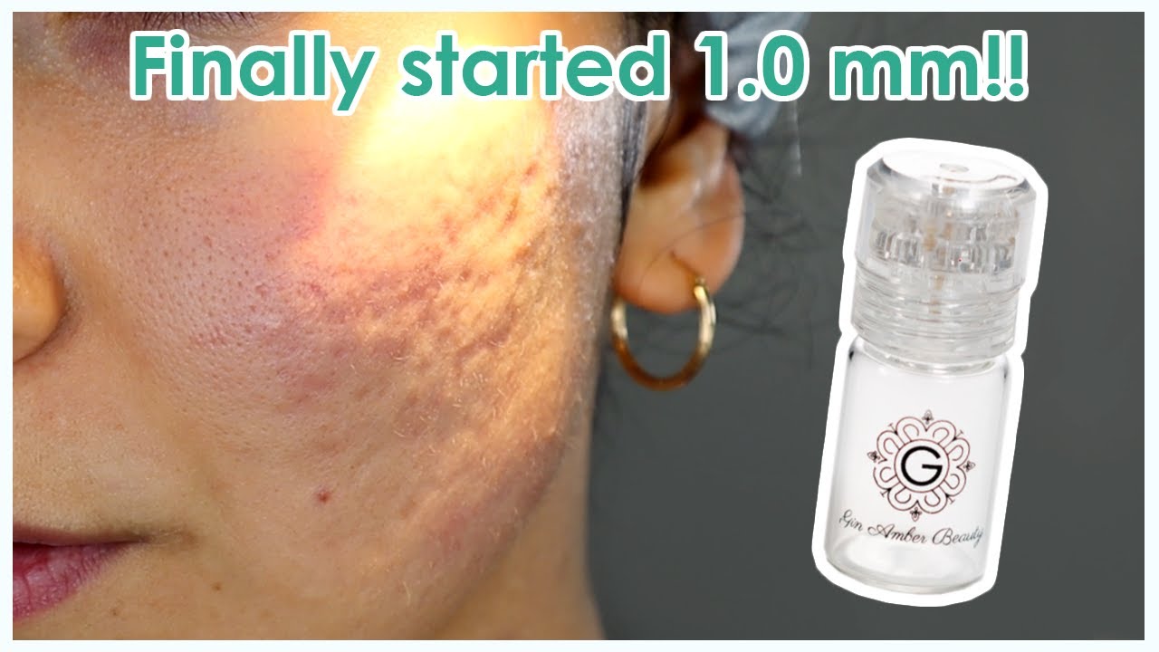 Finally started my 1.0 mm microneedling journey!