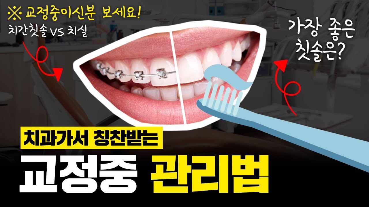 치아교정중 양치질방법 총정리 [워터픽 / 치간칫솔 / 첨단칫솔 / 교정용칫솔 / 왁스]