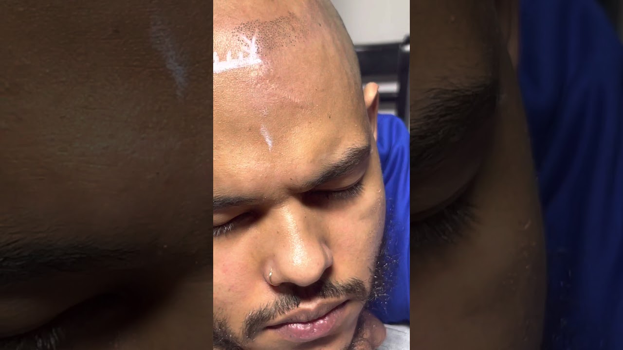 How to create the PERFECT HAIRLINE /ScalpMicropigmentation