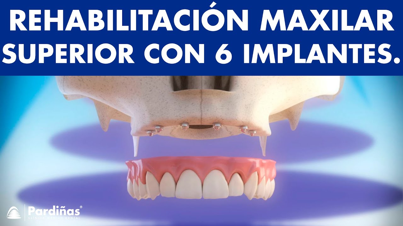 Dentadura fija - Rehabilitación del maxilar con 6 implantes ©