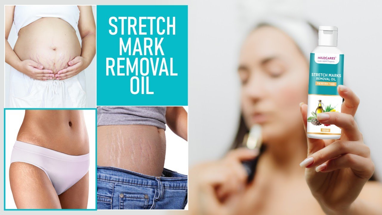 Stretch Marks Oil | Best Stretch Marks Oil | Stretch Mark Removal Oil @MildCaresOfficial #Mildcares