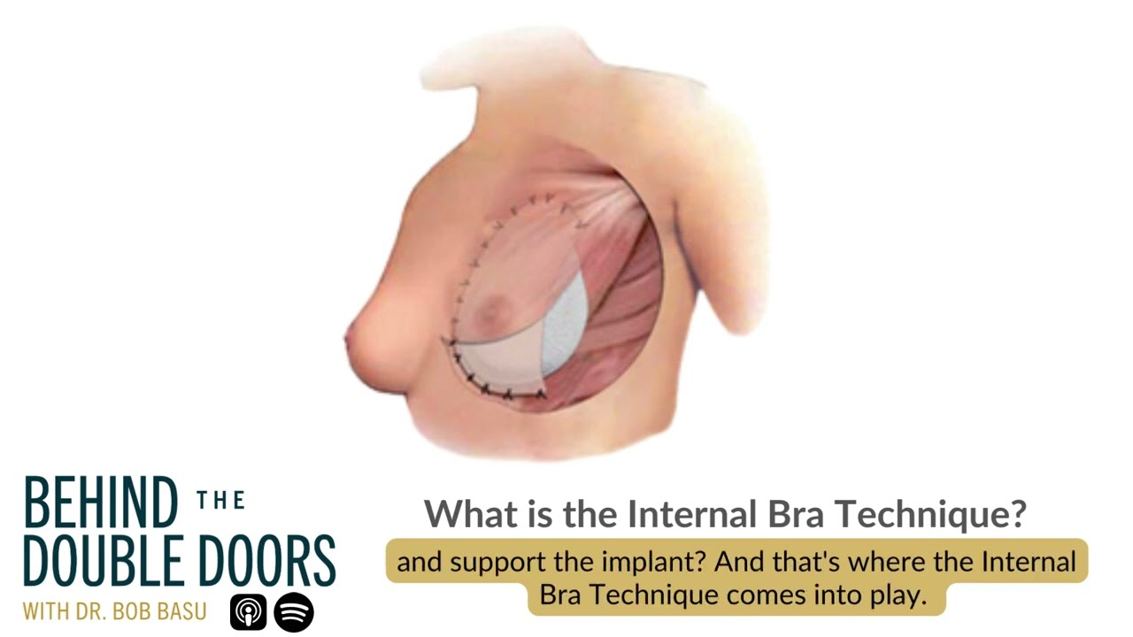 What is the Internal Bra Technique?