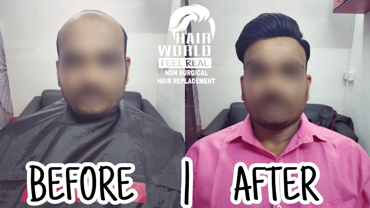 BEFORE & AFTER NON SURGICAL HAIR REPLACEMENT | HAIR PATCH | HAIR SYSTEM | HAIR WORLD