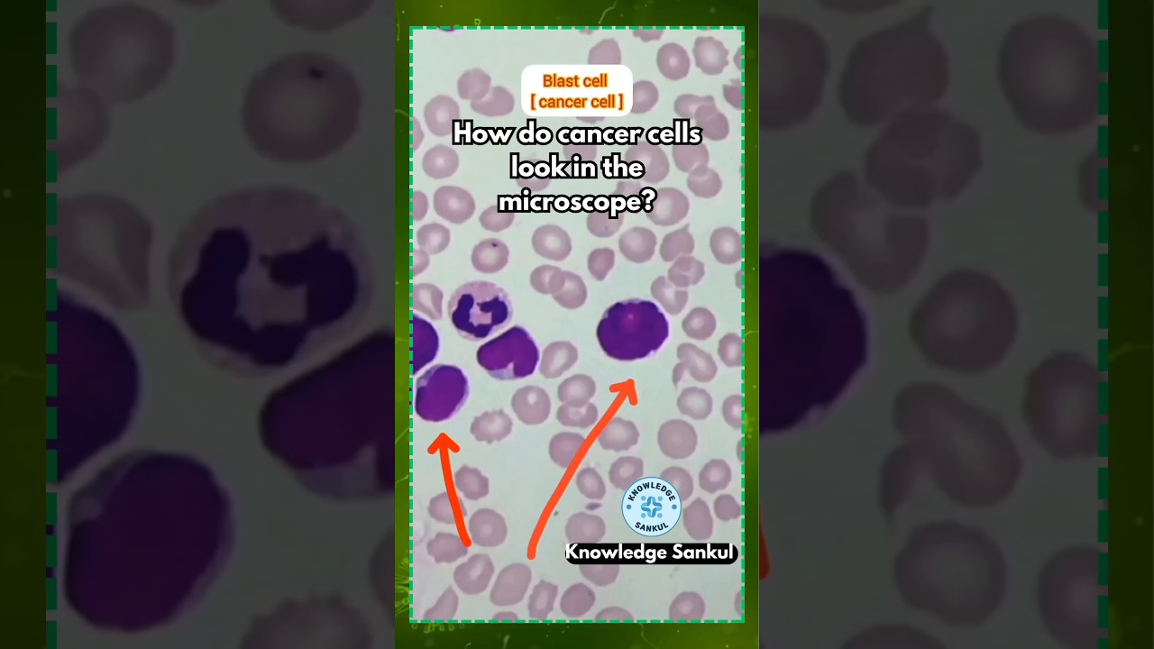 How do cancer cells look in the microscope? 
