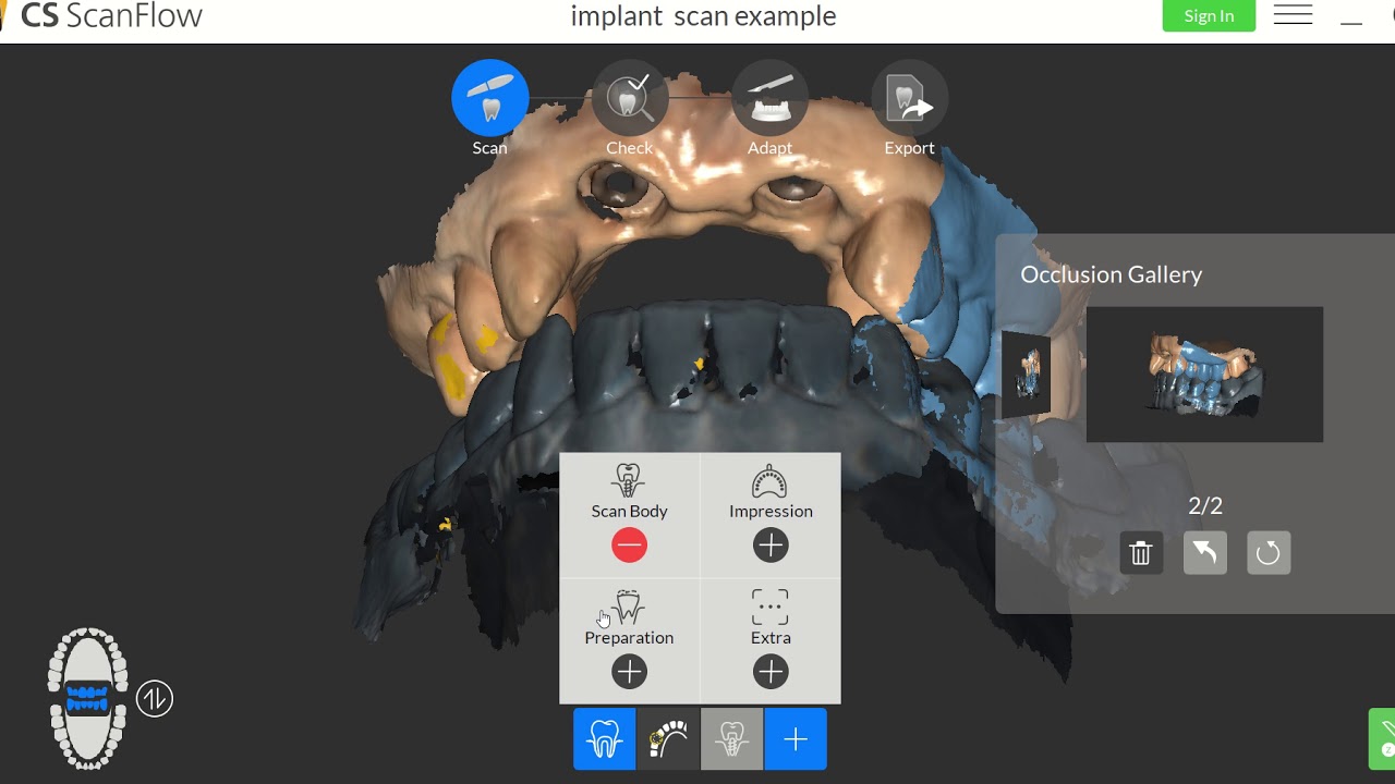 how to scan multiple implants sites using one scan body