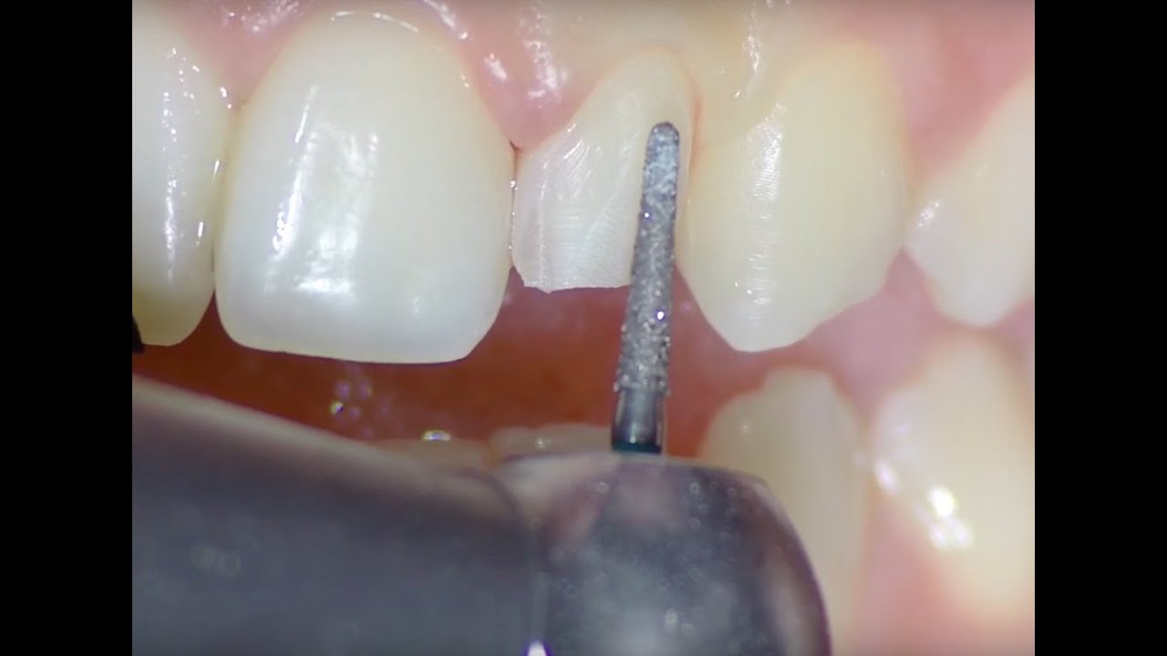 lamina kesim - Laminate veneer preparation, digital impression and temporary restoration.