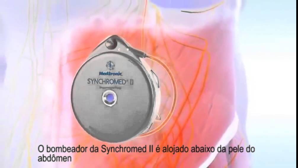 How a Baclofen Pump Works pt