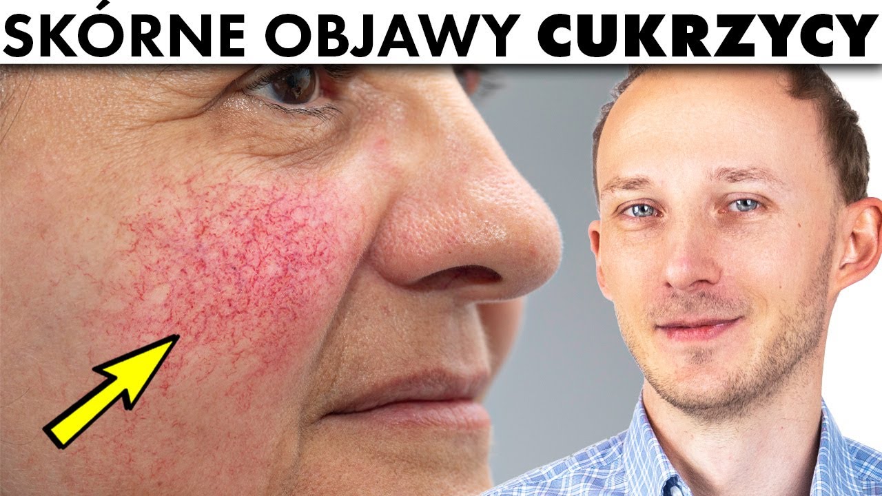 Masz TO na skórze? Zbadaj poziom cukru! Insulinooporność | Dr Bartek Kulczyński