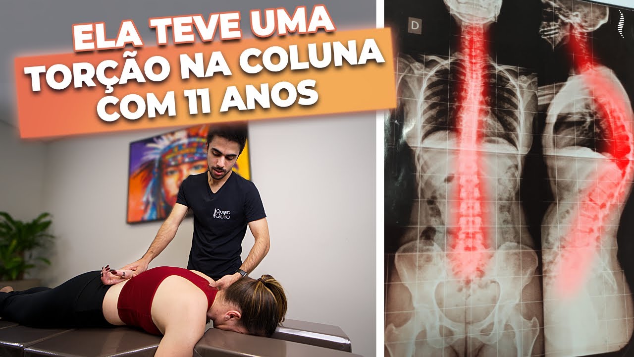TRATAMENTO DE ESCOLIOSE E HIPERCIFOSE COM QUIROPRAXIA