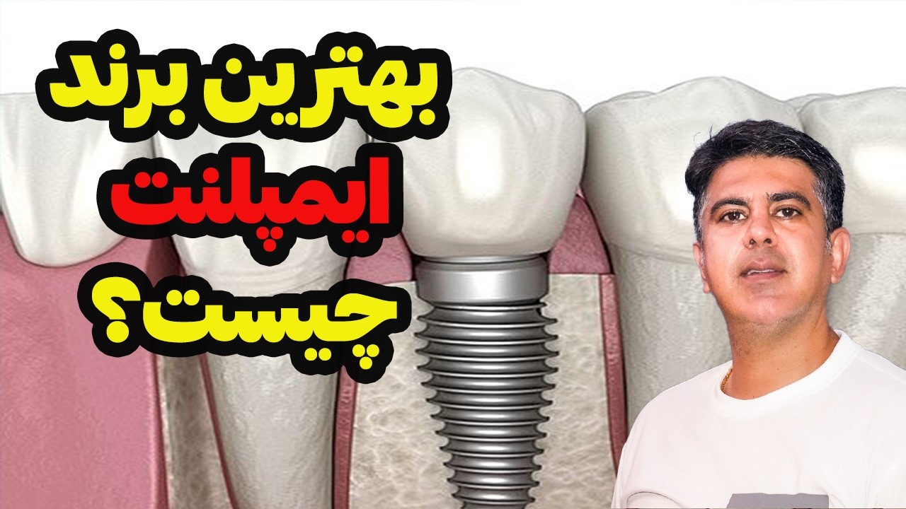 بهترین ایمپلنت : برند ، قیمت و هر انچه شما  باید بدانید