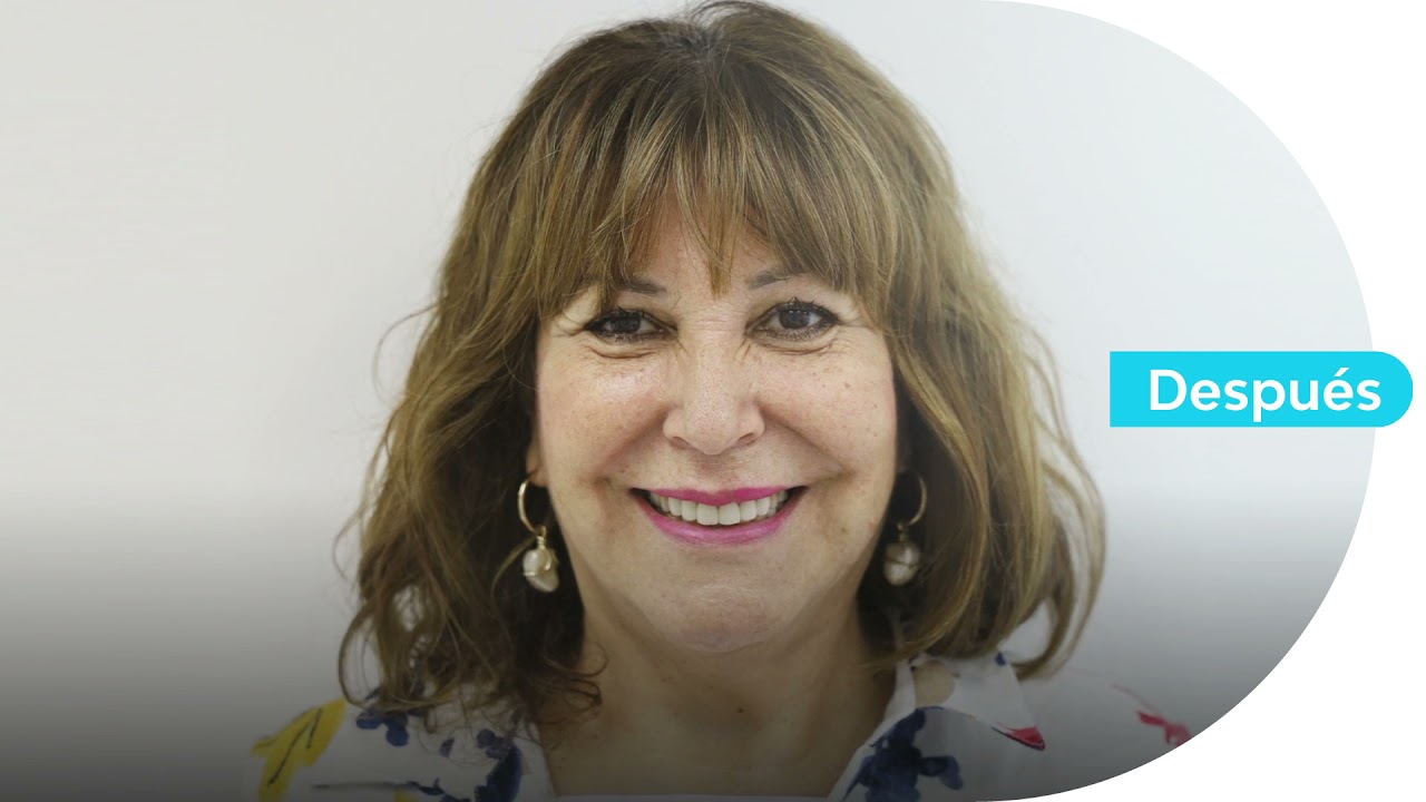 Testimonio Minilifting Facial / Dr. Rolando González Ciriano