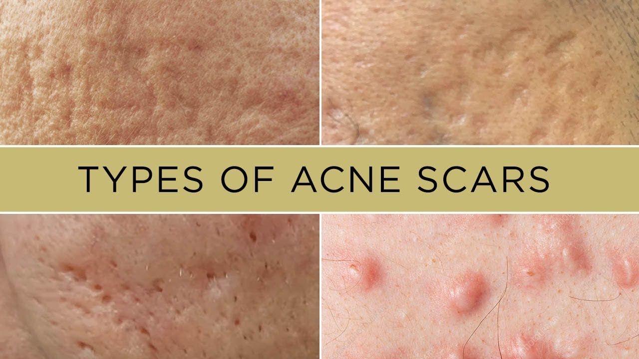 How to treat different TYPES OF ACNE SCARS