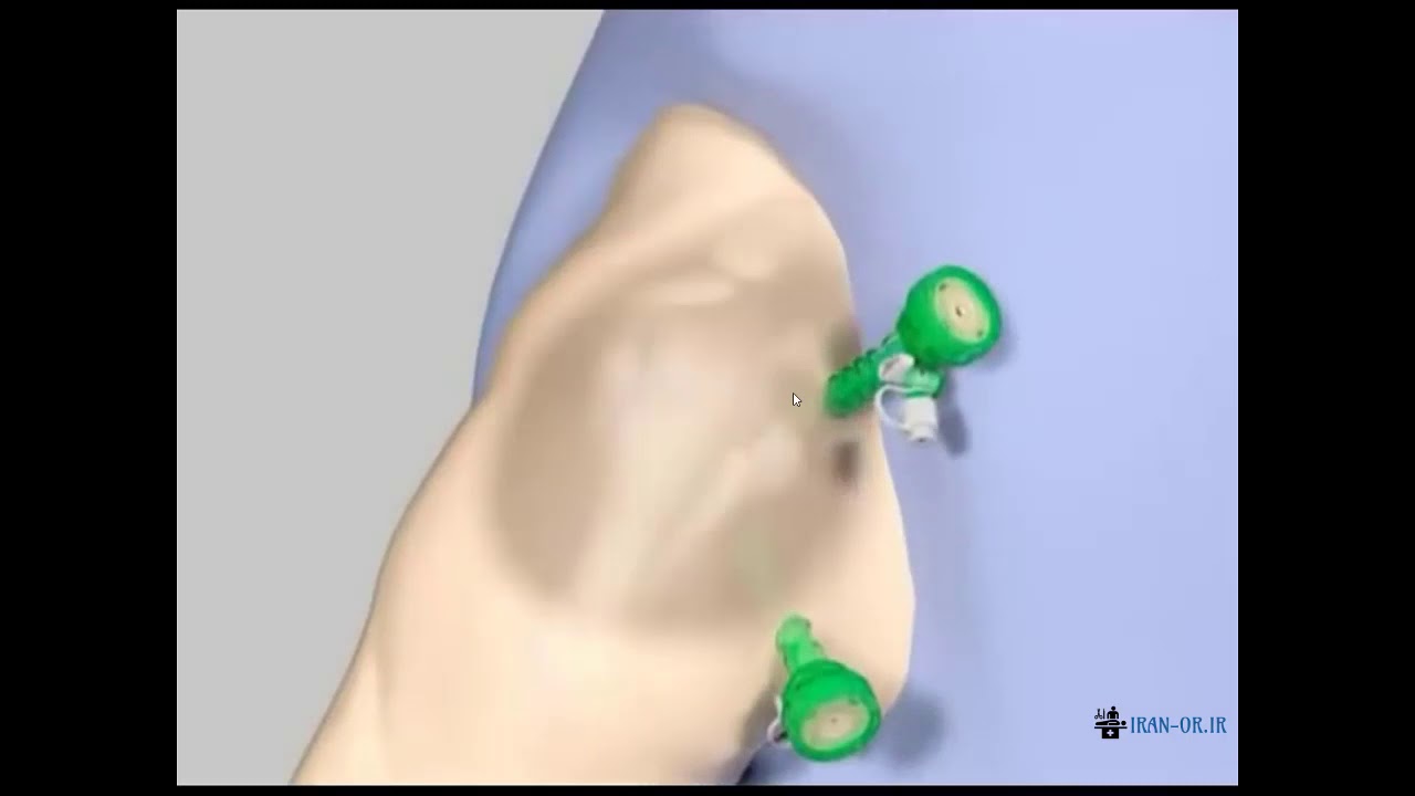 Bankart Lesionآموزش جراحی آرتروسکوپی بنکارت با دوبله فارسی