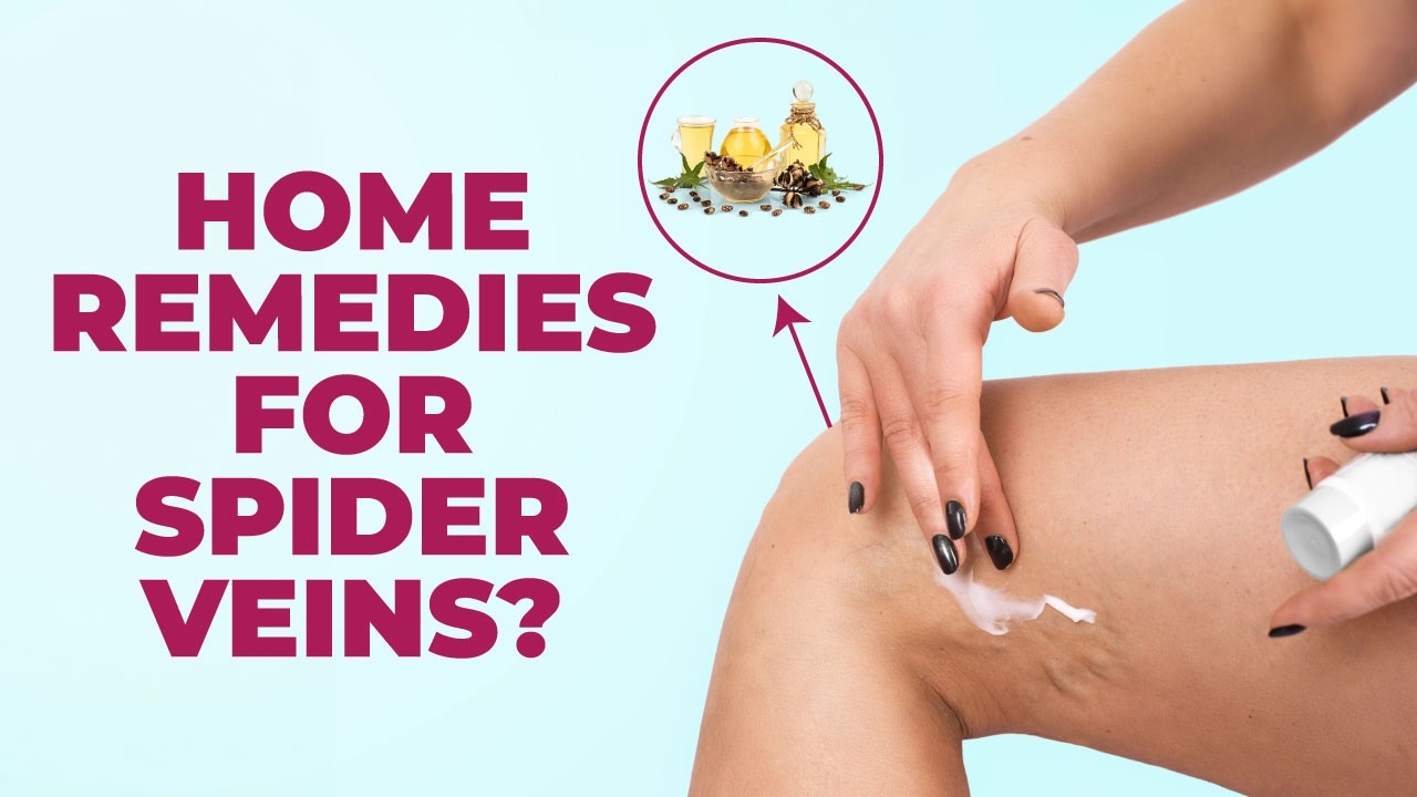 Do Natural Remedies Work for Spider Veins? | Home Remedies to Treat Spider Veins