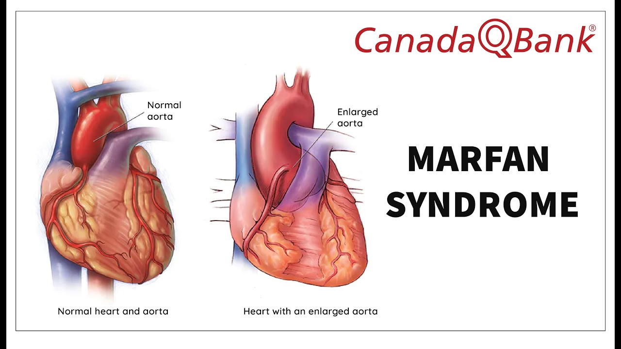 Marfan Syndrome: Signs, Diagnosis & Management | Connective Tissue Disorders | CanadaQBank