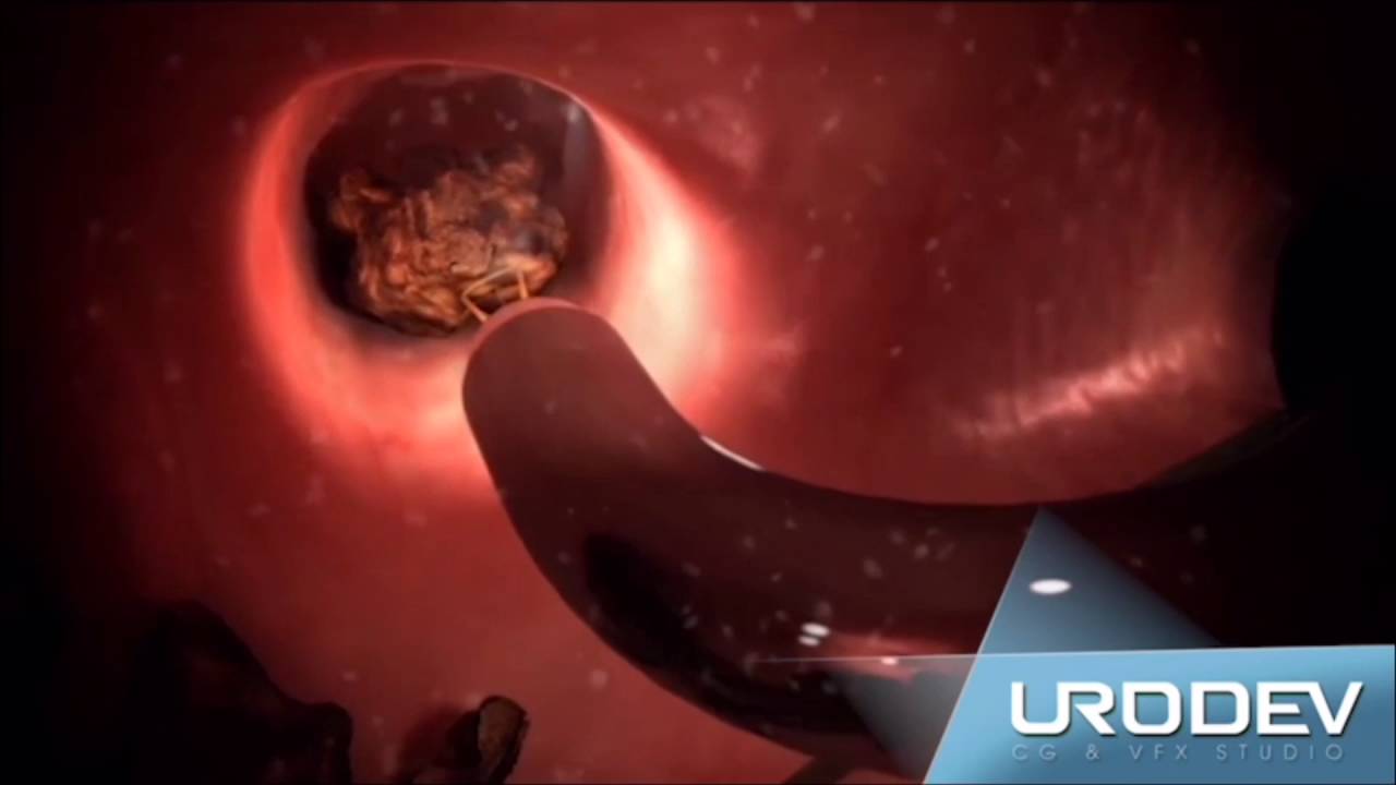 URETERORRENOLITOTRIPSIA FLEXIVEL LASER CALCULOS RENAIS FINAL