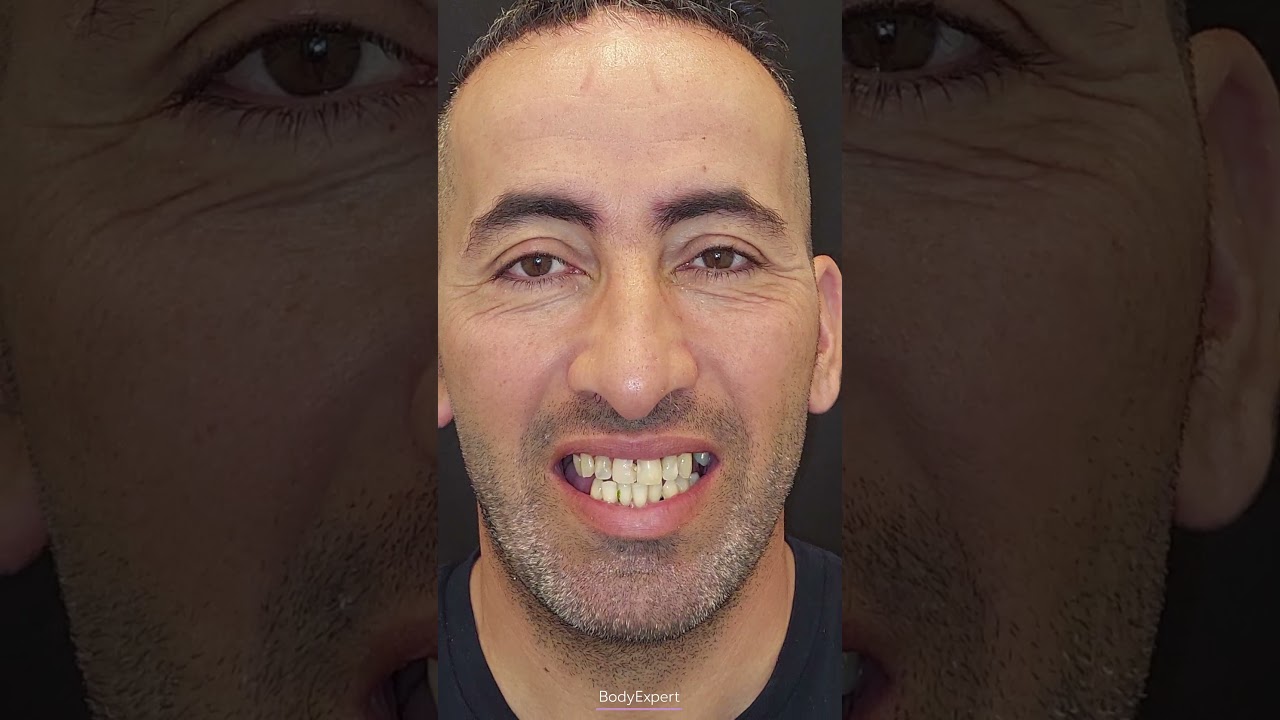 DENTIST IN TURKEY | 🦷 Faouzi's testimony: 3 dental implants + 24 Emax crowns | BODYEXPERT