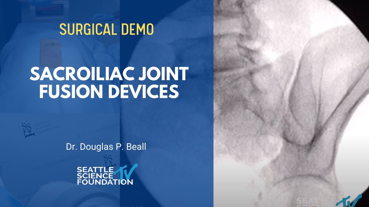 Sacroiliac Joint Fusion Devices - Ramana Naidu, M.D.