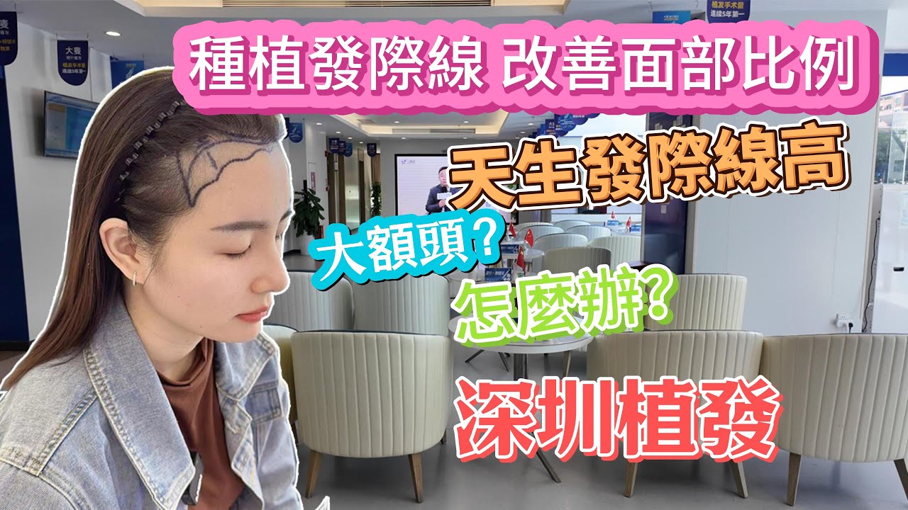 [神州穿梭.深圳#1007] 深圳植髮 天生髮際線高 大額頭怎麼辦 種植髮際線 改善面部比例 微創手術 植髮 | 大麥微針植髮 #深圳植发#深圳好去处 #北上消费