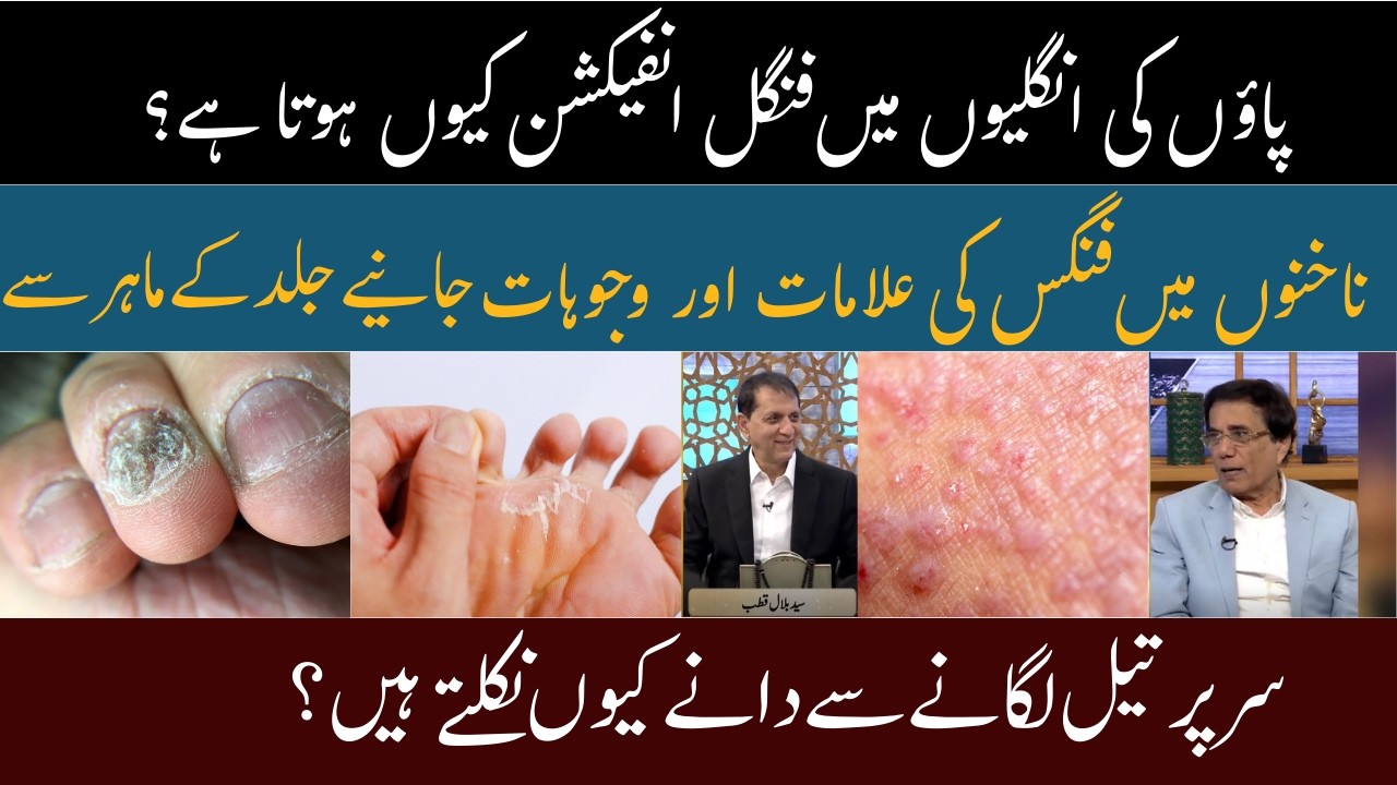 How to Cure Fungal Or Eczema Infection?