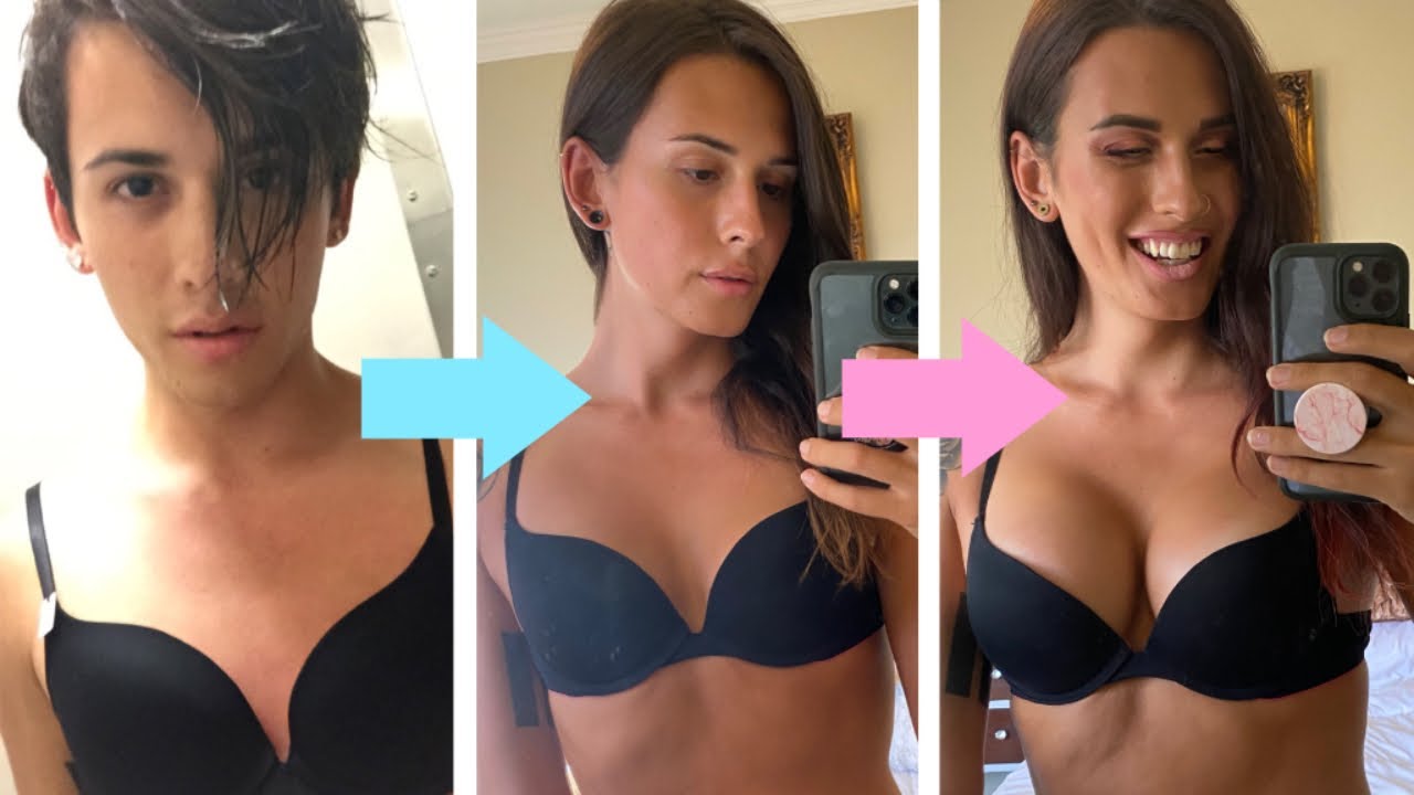 Trans Breast Aug Journey | Rose Montoya