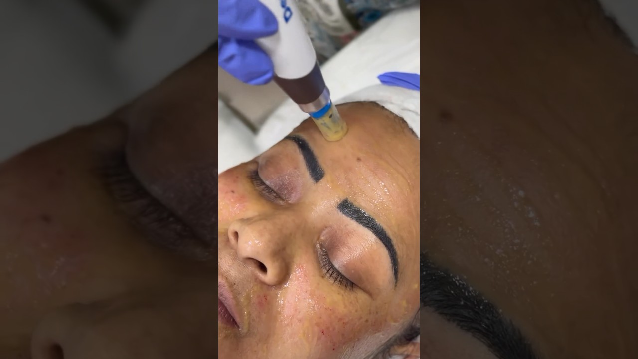 Derma pen 4 treatment 