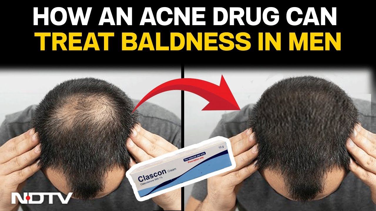 Male Pattern Baldness | How An Acne Drug Can Treat Male Pattern Baldness | Explained