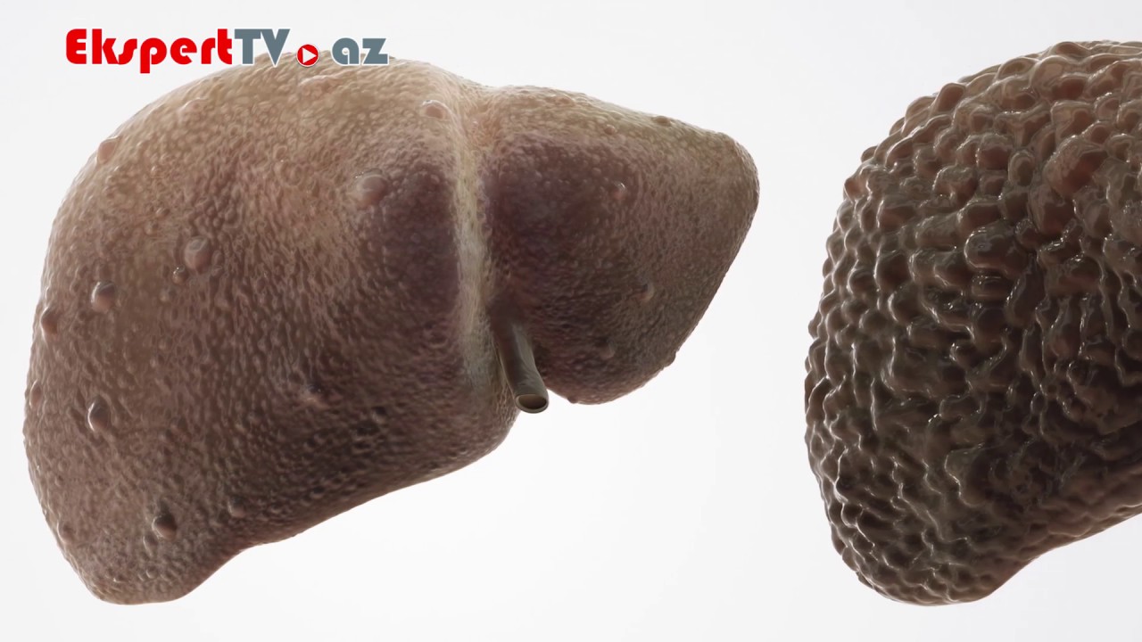 Qaraciyər sirrozu m&uuml;alicə olunan xəstəlikdirmi?