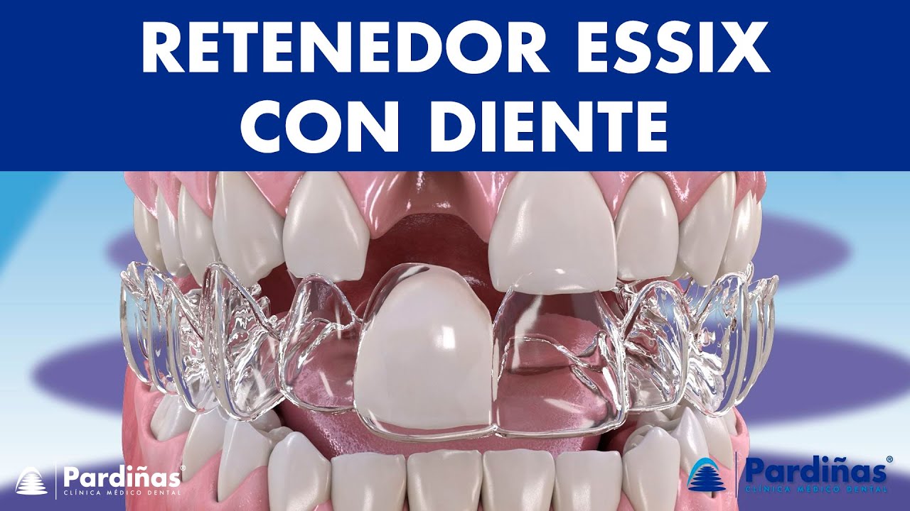 Retenedor ESSIX con diente - Una soluci&oacute;n provisional para los DIENTES FALTANTES &copy;