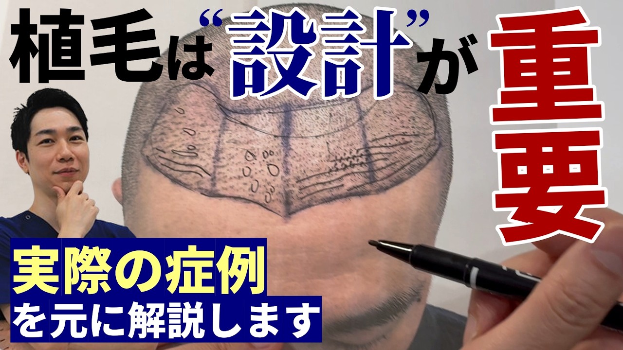 【手術前デザインを図解】トルコで4000株の植毛手術→なぜ追加2000株？9ヶ月後の経過を医師が丁寧に説明