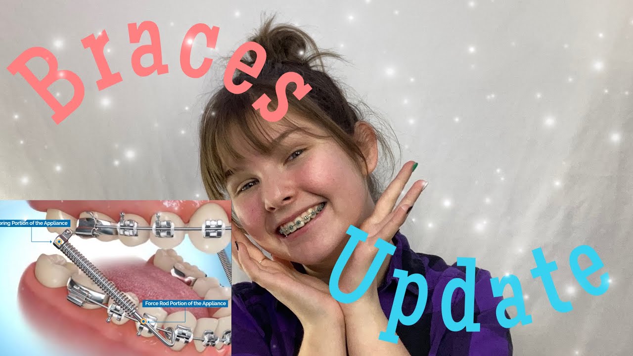Braces update!  I got springs!