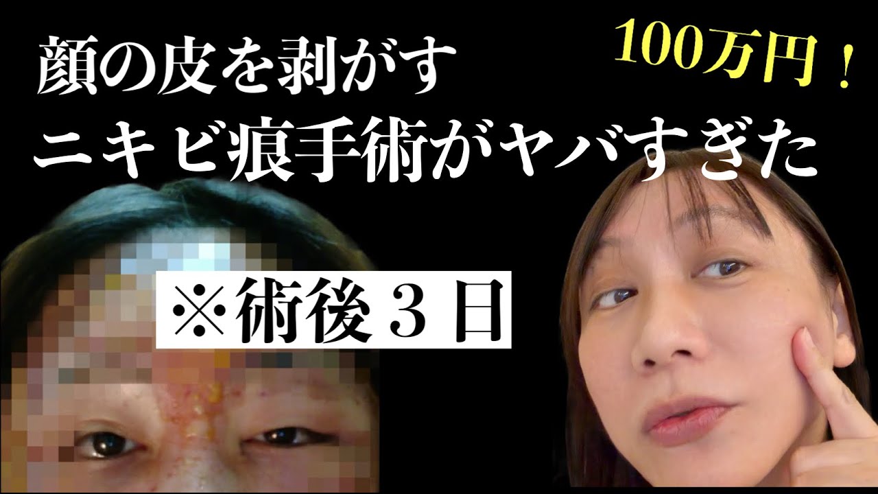 顔の皮を剥がして治療するニキビ痕美容手術が100万円したのに効果なくて逆にスタンディングオベーション