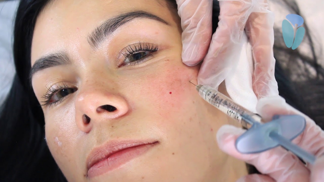 Aplicación de Ácido Hialurónico con Voluma de Júvederm por la Dra. Claudia García