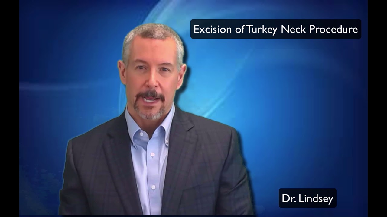 Excision of Turkey neck deformity by Dr. Lindsey | McLean | Virginia | Washington | DC