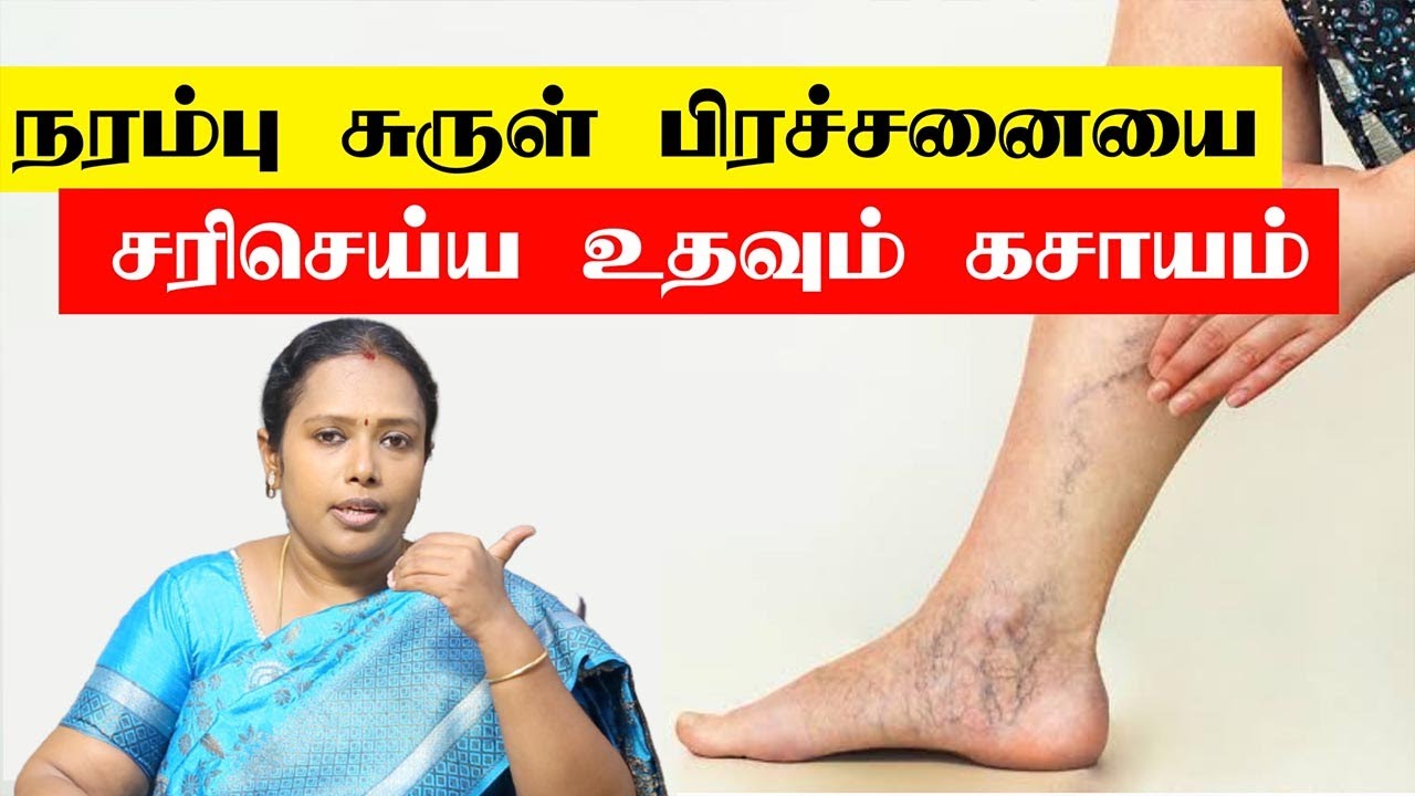 நரம்பு சுருட்டல் எதனால் ஏற்படுகிறது? தீர்வு என்ன? Varicose veins | Dr.Rajalakshmi | ASM INFO