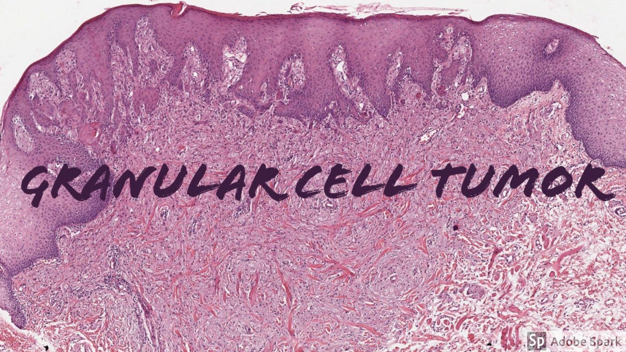 Granular Cell Tumor: 5-Minute Pathology Pearls