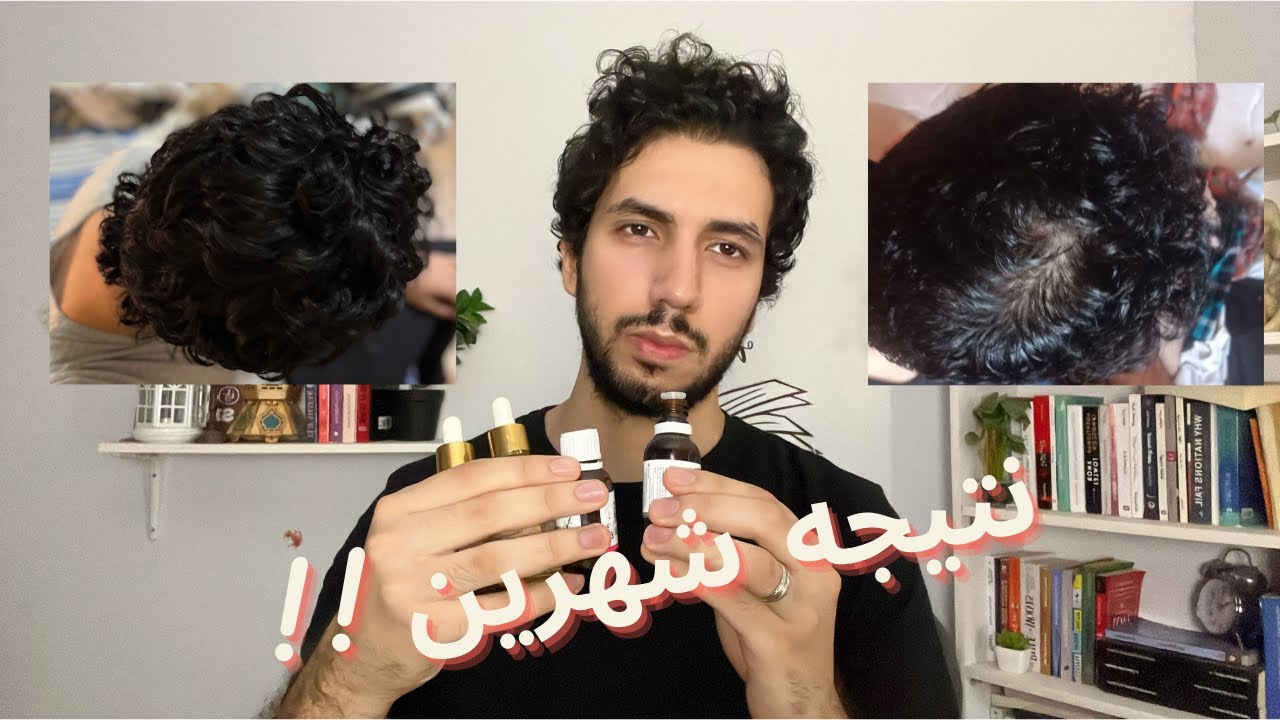 زيوتي الخاصه للصلع وانبات الشعر و نتيجه شعري بعد شهرين