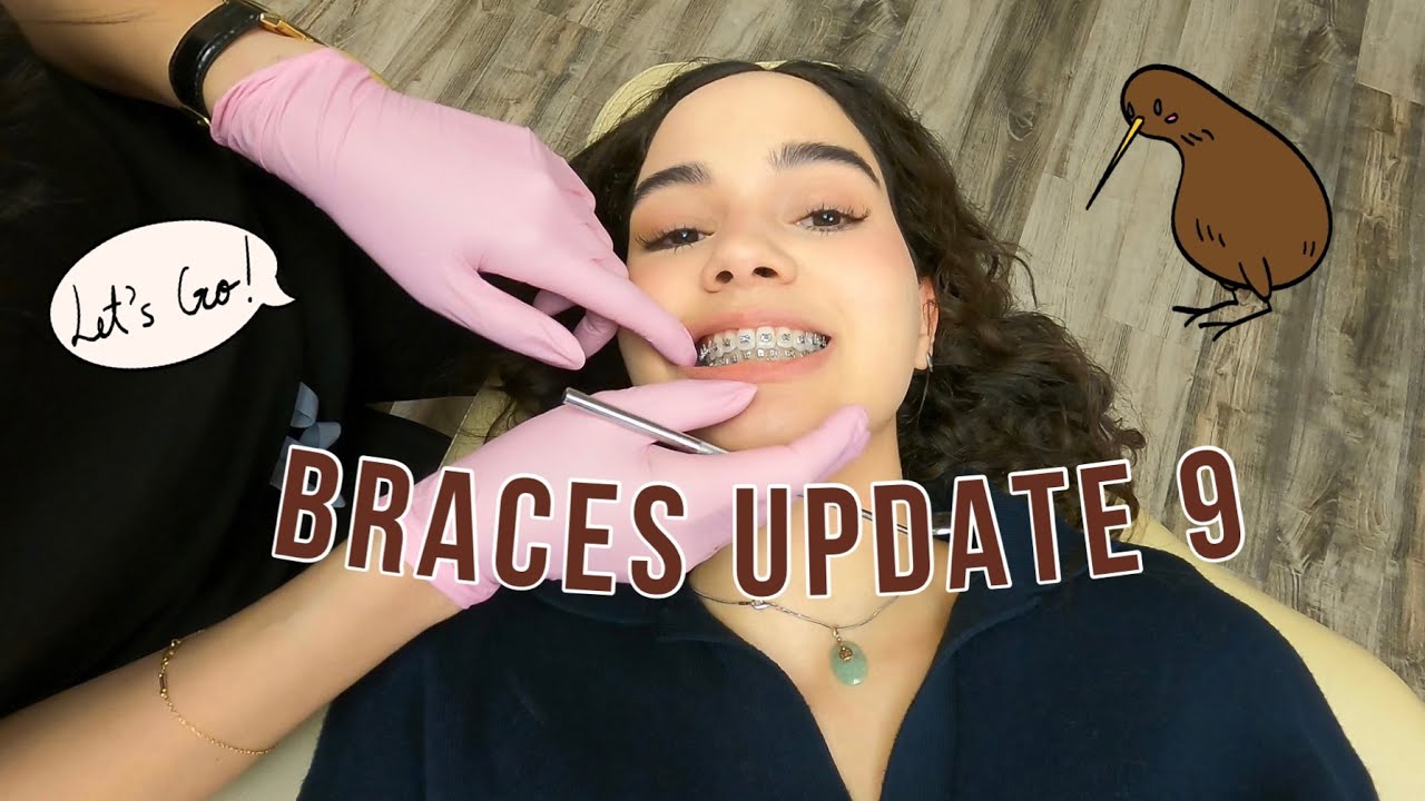 Braces Update 8 🦷 (Completing one month with elastics and completing 8 months with braces)