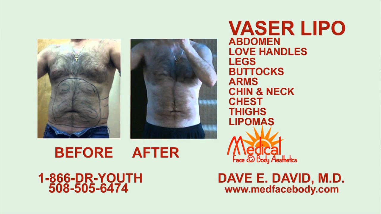 Vaser Lipo by Dr. Dave David