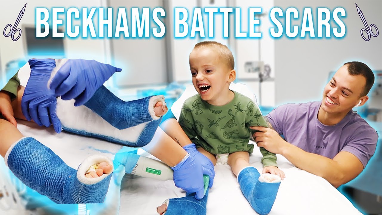 BECKHAMS CASTS ARE OFF! OFFICIAL LEG REVEAL POST SURGERY!