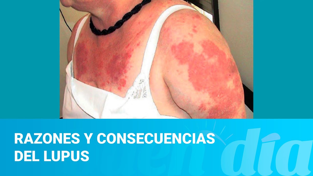 ¿Tiene lupus? Le explicamos las razones y consecuencias de la enfermedad